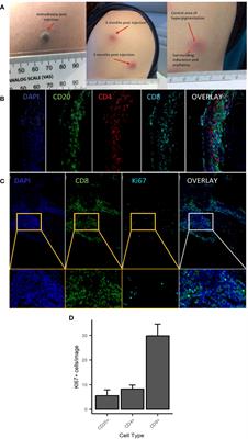 Single-cell RNAseq identifies clonally expanded antigen-specific T-cells following intradermal injection of gold nanoparticles loaded with diabetes autoantigen in humans